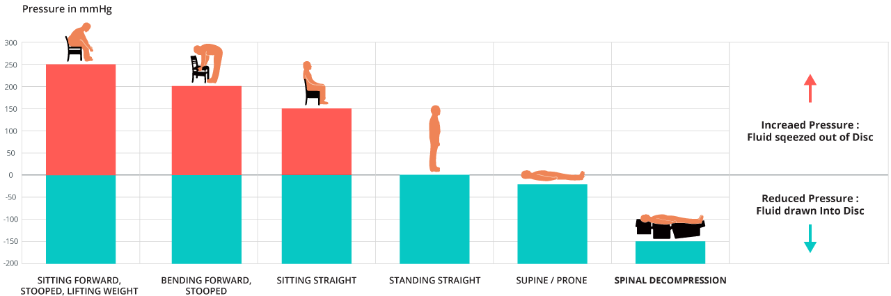 Non Surgical Spinal Decompression in Naples, FL , Pressure on the Spine